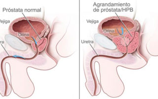 Patología benigna de próstata