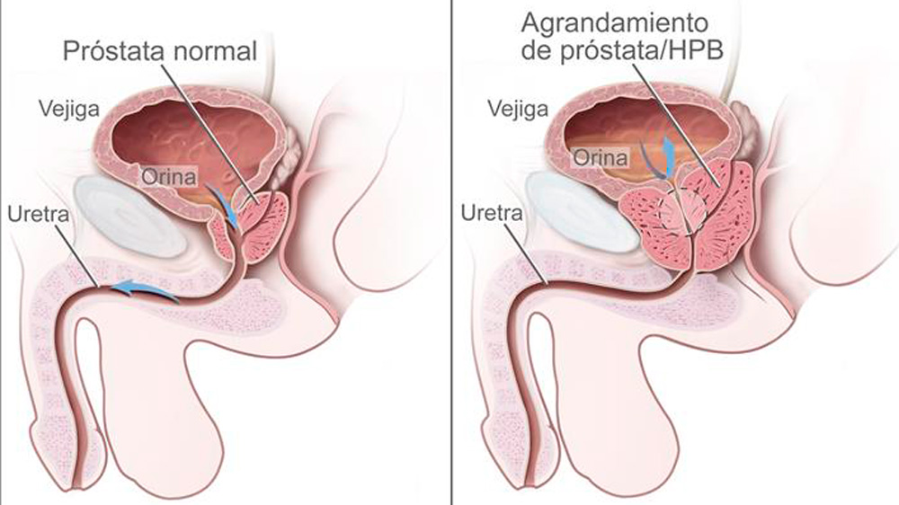 Patología benigna de próstata
